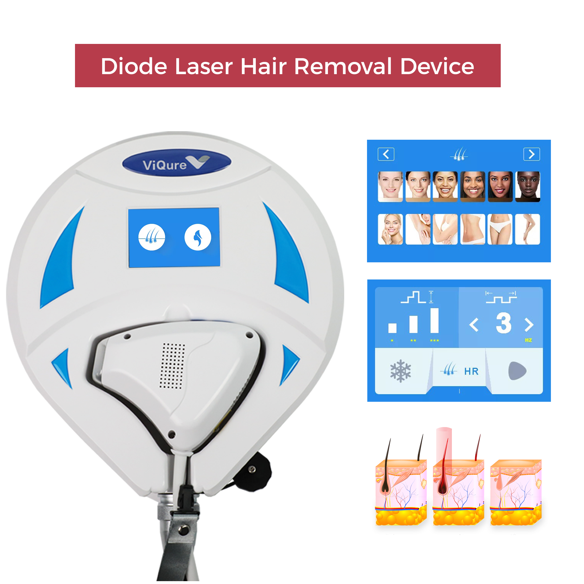 Diode Laser Hair Removal Device – ViQure